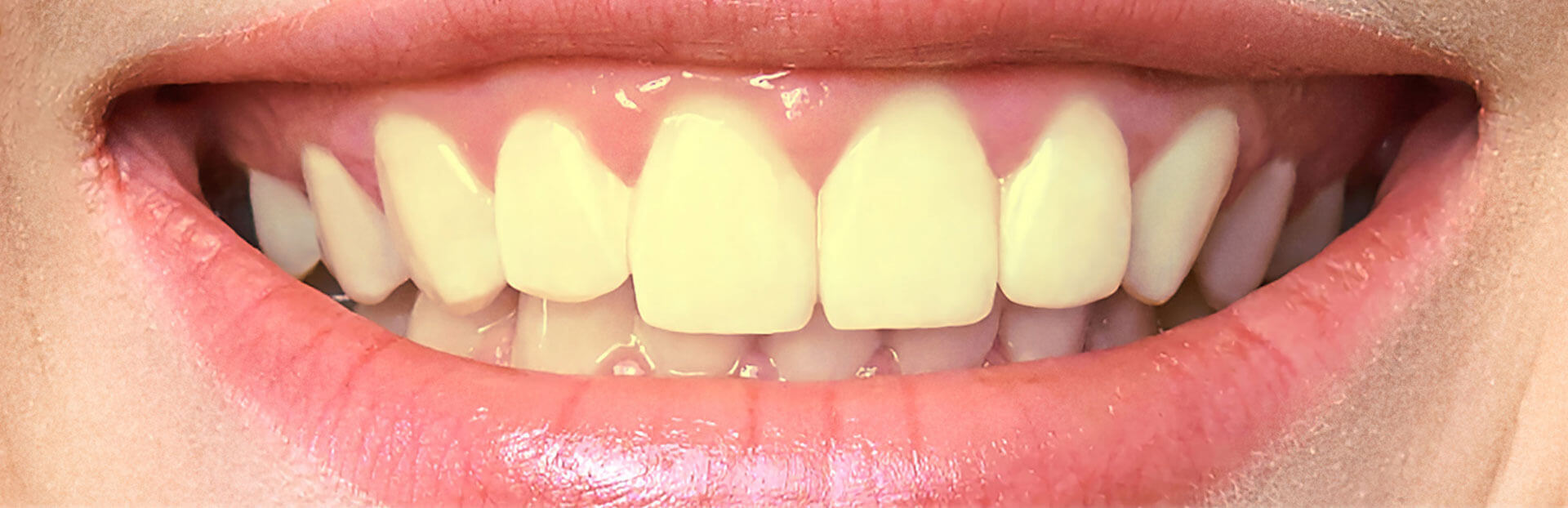 teeth-yellow