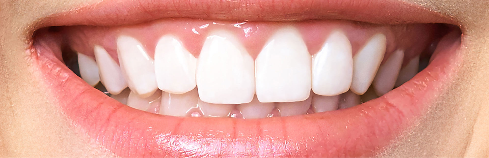 teeth-white